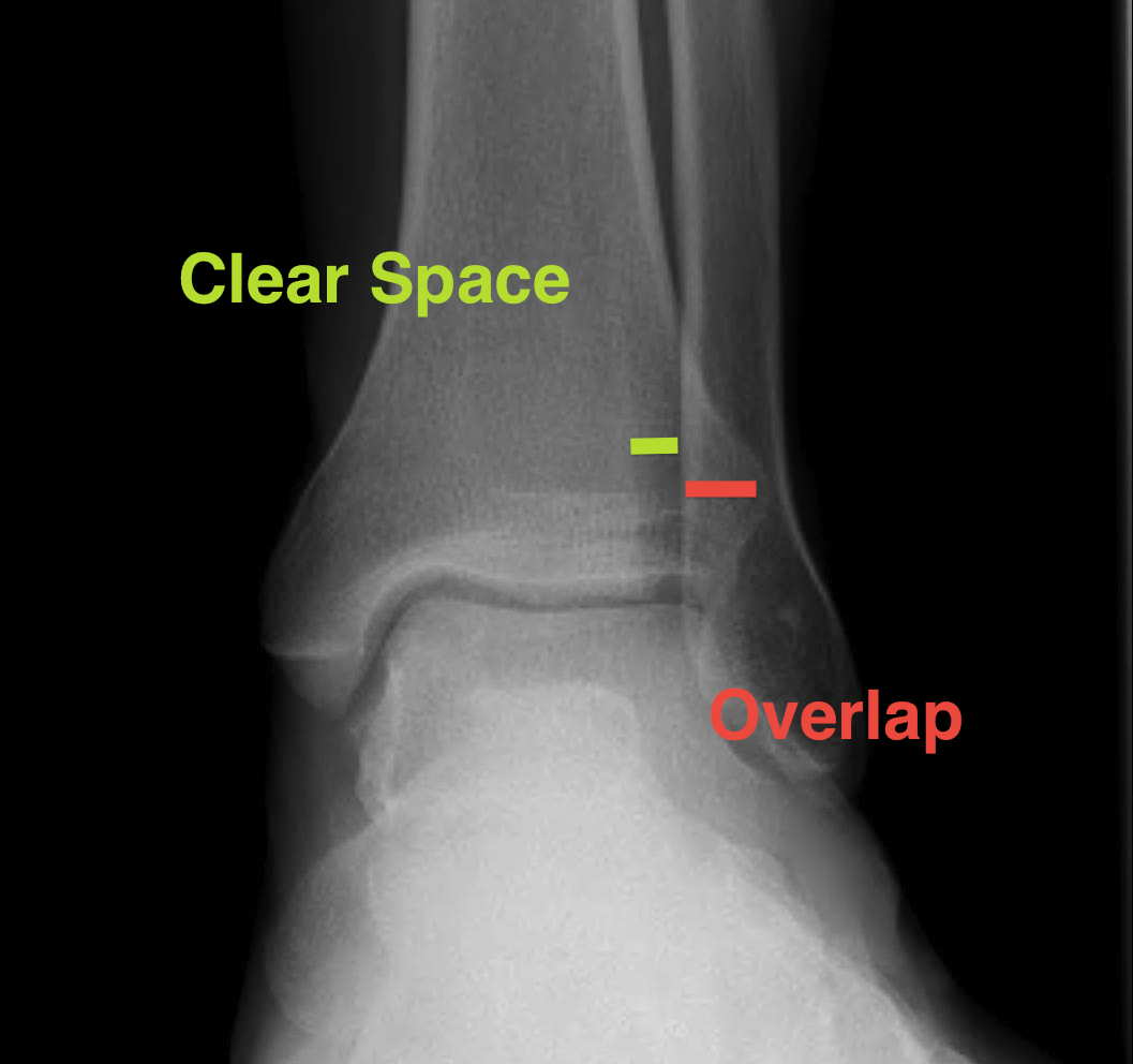 Ankle AP Xray Syndesmotic Measurements